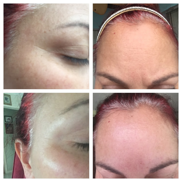 Furlesse Wrinkle Patches before and after images